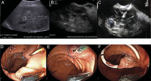 A. Ecografía hepatobiliar donde se identifica un absceso hepático mayor de 10cm. B. Visión lineal por ultrasonido endoscópico del absceso hepático. C. Punción transgástrica del absceso. D. Paso de un stent metálico cubierto; se observa drenaje abundante de material purulento denso. E. Dilatación del extremo proximal del stent. F. Paso de catéter doble cola de cerdo coaxial al stent metálico.