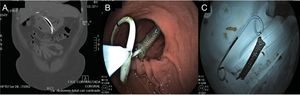 A. TAC coronal realizada 3 meses después, donde se observa la resolución completa del absceso y la persistencia de los stents. B. Visión endoscópica del momento del retiro de ambos stents. C. Stent plástico doble cola de cerdo y stent metálico, ya retirados de la paciente.