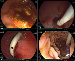 A) Litotripsia con láser mediante sistema SpyGlass™. B) Catéter doble cola de cochino en fístula. C y D) Catéter migrado a duodeno.
