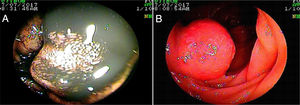 Tumor neuroendocrino bien diferenciado; A. VCE B. Enteroscopia de doble balón anterógrada.