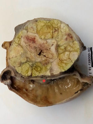 Imagen macroscópica del hepatocarcinoma, en donde se observa la parte distal del estómago, involucrando la pared y la mucosa de la curvatura menor del estómago (?).