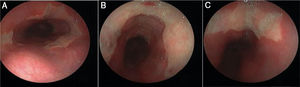 La endoscopia gastrointestinal superior en el tercio medio del esófago muestra dos áreas de ulceración de poca profundidad en forma de circunferencia en posición encontrada («úlceras en beso»). A) Las úlceras de 3cm de longitud presentan hiperemia leve en la mucosa circundante (B y C).
