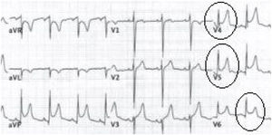Electrocardiograma que muestra elevación del segmento ST de forma difusa en las derivaciones cardíacas precordiales.