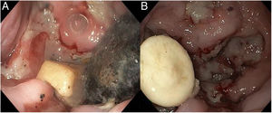 A) Imagen endoscópica del divertículo epifrénico con la presencia de detritus alimenticios (ciruela). B) Imagen endoscópica del divertículo epifrénico con la presencia de cuerpo extraño (pastilla).