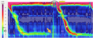 Trazado postprandial de manometría esofágica de alta resolución sin impedancia. Se observa contracción gástrica sobre 30mmHg (onda R) (flecha), apertura de esfínter superior (óvalo) y deglución secundaria (*) en conjunto con síntoma (**) referido por paciente.