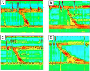 Manometría esofágica de los pacientes con obstrucción en el tracto de salida de la unión esofagogástrica (UEG). Pacientes con historia de disfagia posfunduplicatura. La manometría de alta resolución fue consistente con obstrucción al flujo del tracto de salida de la UEG. La presión de relajación media fue de 24 mmHg, la peristalsis fue normal en todos los casos.