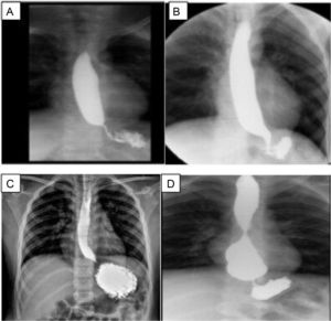 Esofagograma de los pacientes posterior a funduplicatura. A) Caso 1, sobredistensión de la luz esofágica al paso del bario. La unión esofagogástrica (UEG) se observa por debajo del diafragma; B) Caso 2, estrechez de la de la UEG; C) Caso 3, el esófago sobredistiende discretamente en sus tres tercios, con adelgazamiento de la unión esofagogástrica; D) Caso 4, esófago de calibre conservado en los dos primeros tercios, pero con gran aumento de su calibre en el tercio distal, punta roma e incluso con imagen redondeada, y reducción de calibre en la UEG, probable sobreeficiencia de la funduplicatura.