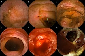 Imágenes de cápsula endoscópica de intestino delgado en pacientes con enfermedad injerto contra huésped gastrointestinal. a) Eritema difuso y puntos rojos. b) Úlceras en sacabocado. c) Úlceras cubiertas de fibrina. d) Desfacelación de la mucosa. e) Mucosa denudada y hemorragia activa. f) Estenosis ulcerada.