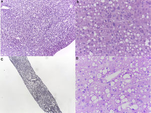 Estudio transoperatorio de biopsias hepáticas congeladas de los casos descartados. a) Microfotografía de biopsia en cuña transoperatoria del caso #6 con esteatosis macrovesicular del 50% y microvesicular del 5% (aumento 10x). b) Detalle de esteatosis en caso #6 (aumento 40x). c) Microfotografía de biopsia hepática percutánea del caso #8 con esteatosis macrovesicular del 40% y microvesicular del 20% (aumento 10x). d) Magnificación 40x del caso #8.