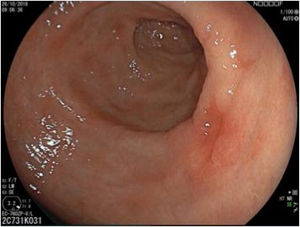 Lesión deprimida tipo 0IIc en la cara posterior del antro en endoscopia con luz blanca. La histología demostró adenocarcinoma in situ.