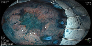 Espécimen de ESD en bloque de 5cm fijado y estirado con alfileres. Obsérvese la zona deprimida con coloración con índigo carmín al 0.4%. La histología demostró adenocarcinoma bien diferenciado del tipo intestinal con invasión de la lámina propia asociado a displasia de alto y bajo grado. Márgenes laterales y profundos libres y sin invasión linfática o vascular. Resección R0 con criterios curativos.
