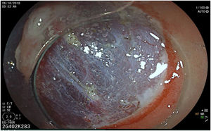 Incisión circunferencial de la mucosa evidenciando la capa submucosa (ERBE VIO 200S, Endocut I, Efecto 2).