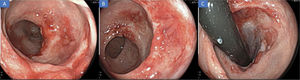 A. Rectosigmoidoscopia donde se evidencia mejoría notable de los cambios inflamatorios 2 semanas tras tratamiento: primera y segunda válvula de Houston. 2B. Notable mejoría de los cambios inflamatorios en recto distal. 2C. Retroflexión del recto mostrando la cicatrización mucosa e incluso mejoría de los hallazgos en cercanía del canal anal.