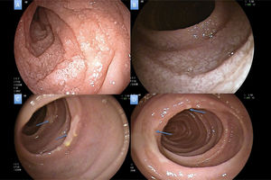A) Atrofia segmentaria en duodeno distal. B) Cambios de atrofia severa homogénea en yeyuno. C y D) Adelgazamiento de la mucosa en yeyuno medio con presencia de ulceraciones superficiales recubiertas de fibrina en parches (flechas azules).
