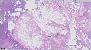 Corte histológico con tinción de hematoxilina-eosina a 50 aumentos en que se observa paniculitis lobulillar con extensa necrosis de adipocitos y adipocitos sin núcleo con depósito granular fino y basófilo.