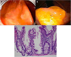 Adenoma serrado sésil/pólipo. A. Pólipo serrado sésil mayormente plano en el colon derecho. Nótese la coloración similar a la del colon normal adyacente, la escasez de vasos sanguíneos en la superficie de la lesión y la acumulación de desechos amarillos en los bordes. B. Pólipo serrado sésil en el colon derecho. Nótese la prominente «cubierta de moco amarillo». C. Apariencia histológica de un adenoma serrado sésil/pólipo. Tiene arquitectura de cripta distorsionada, con patrón serrado marcado en la base de las criptas; las criptas basales están dilatadas (imágenes endoscópicas tomadas con autorización de: Rex D. Serrated Polyps in the Colon. Gastroenterol Hepatol 2014;10(10). La imagen histológica fue tomada con autorización: Kuo E. Adenoma serrado sésil. [consultado 2 Jul 2020]. Disponible en: http://www.pathologyoutlines.com/topic/colontumorsessileserrated.html.