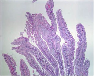 Sección histológica de un adenoma serrado tradicional, con patrón de crecimiento viliforme protuberante con sierras tipo corte.Tomada de: Kuo E, González R. Adenoma serrado tradicional [consultado 2 Jul 2020]. Disponible en: http://www.pathologyoutlines.com/topic/colontumortraditionalserratedadenoma.html.