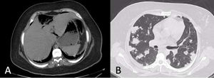 a) Tomografía computarizada de abdomen con absceso hepático roto. b) Tomografía computarizada de tórax con múltiples nódulos bilaterales cavitados.