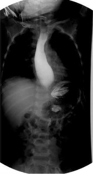 Serie esofagogastroduodenal que muestra esófago dilatado a nivel de la unión esofagogástrica, disminución acentuada de la luz esofágica distal e imagen en «pico de ave».