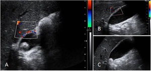 Signos de colecistitis aguda en ultrasonido. A) Vascularidad aumentada en vesícula biliar. B) Engrosamiento de pared. C) Colelitiasis.