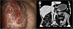 A) Imagen laparoscópica del procedimiento con vista sobre el lóbulo hepático izquierdo y el hemangioma gigante. B) Tomografía computarizada en corte coronal a 12 meses del procedimiento quirúrgico donde se aprecia ausencia de segmentos laterales II y III, desde el ligamento falciforme.