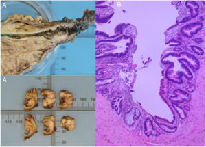 A) Imagen macroscópica de vía biliar resecada en pancreatoduodenectomía, con 2 sitios de tumor (cerca de la bifurcación de los hepáticos y de la ampolla de Vater). B) Neoplasia papilar intraductal con focos de displasia de alto grado, en el colédoco distal extra- e intrapancreático, focos microscópicos de adenocarcinoma bien diferenciado (G1) de tipo intestinal invasivo a la pared del colédoco, con displasia de bajo y alto grado en el borde quirúrgico de la vía biliar.