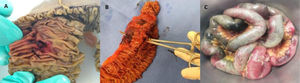 A) Espécimen quirúrgico de resección de yeyuno que muestra perforación total. B) Intestino delgado reseccionado, mismo paciente, mostrando perforación total y hematoma en el mesenterio. C) Intestino delgado reseccionado; se pueden observar áreas irregulares de necrosis.
