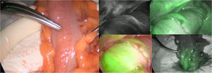 Angiografía por fluorescencia con verde de indocianina.