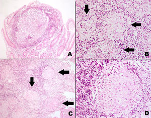 A) Lesión pseudopolipoidea en intestino delgado; se observa formación de nódulo con acúmulo central de células histiocitarias y periferia de linfocitos (H&E 100×). B) Intestino delgado con células claras de histiocitos agrupadas y organizadas con tendencia a formar microgranulomas (flechas) (H&E 200×). C) Intestino delgado con granulomas sólidos múltiples (flechas) e infiltrado linfocítico difuso. (H&E 100×) D) Granuloma en intestino delgado sólido, con células gigantes histiocíticas multinucleadas de citoplasma claro. (H&E 200×).