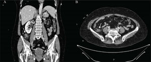 Cortes coronal (A) y axial (B) de TC abdominal con contraste intravenoso en el que se visualiza formación diverticular de aproximadamente 11mm en íleon terminal con cambios inflamatorios de la grasa adyacente y láminas de líquido libre adyacente sugestivo de diverticulitis.