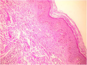 Biopsia de lesiones cutáneas presentando vasculitis leucocitoclástica (tinción hematoxilina-eosina [H&E], ×20).