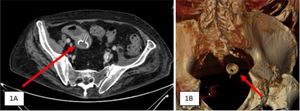A) Tomografía computarizada (TC) que muestra inflamación regional y ectasia de íleon proximal debido a impactación de cuerpo extraño redondo de 2cm de diámetro en el íleon terminal. B) una imagen de reconstrucción con TC 3D que muestra un cuerpo extraño redondo, de 2cm de diámetro, en el íleon terminal.