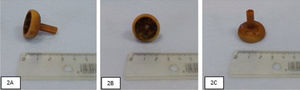 Fotografía de un cuerpo extraño redondo, de 2cm de diámetro, correspondiente a la migración interna de una sonda de gastrostomía endoscópica percutánea.