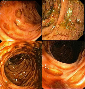 Colonoscopía: extensa distribución de úlceras en sacabocados desde el colon sigmoide al ciego.