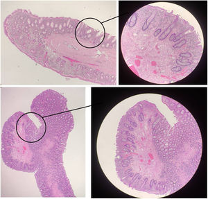 Imagen patológica que muestra formaciones polipoideas, digitiformes, sin displasia con presencia de inflamación aguda y crónica focalmente abscesificada compatible con perforación.
