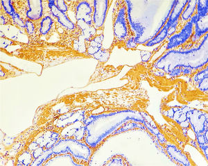 La inmunohistoquímica con actina de músculo liso demuestra la presencia de músculo liso en el pólipo hamartomatoso (100×).