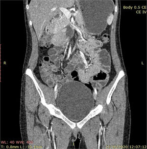 En el corte coronal de entero-TAC se aprecia una lesión hiperdensa de 5cm en la tercera porción de duodeno.
