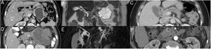 Imágenes de diferentes neoplasias quísticas de páncreas. A.CAM. Lesion quística paucilocular con calcificaciones periféricas en cola de páncreas. B. CAS. Lesión microquística multilocular en cola páncreas. C. IPMN- CP. Dilatación segmentaría del conducto pancreático principal. D. TSP. Lesión heterogénea con componentes sólido, quístico y calcificaciones séptales en cuerpo y cola de páncreas. E. IPMN - RS. Lesión quística bilobulada con comunicación al conducto pancreático principal en cuerpo-cola de páncreas. F. TNE - con degeneración quística. Lesión quística con hipercaptación de medio de contraste y pared engrasada en fase arterial en cabeza de páncreas.