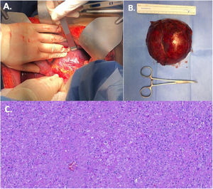 A) Hallazgo intraoperatorio de un tumor hepático grande en el lóbulo caudado. B) Tumor hepático de 10 cm extirpado. C) Carcinoma hepatocelular, células tumorales organizadas en trabéculas delgadas, con un patrón de crecimiento de reemplazo.