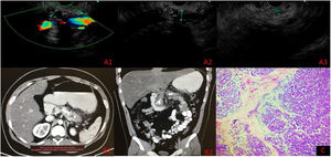A) Ultrasonido endoscópico, medición de conducto pancreático principal. A1) Cuello 7 mm. A2) Cuerpo 10 mm. A3) Cola 3 mm (calcificaciones intraductales en cuerpo y cola). B1-B2) Tomografía computarizada abdominal contrastada. C) Histopatología: Pancreatitis crónica con fibrosis extensa asociado a inflamación crónica.