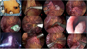 A) Posicionamiento de trocares. B) Apertura de ligamento gastrocólico. C) Estómago fijado a peritoneo para exposición de páncreas. D) Páncreas atrófico. E) Punción de conducto pancreático principal. F) Apertura de conducto pancreático principal. G) Pancreatoscopia. H) Litiasis en conducto pancreático principal. I) Lito posterior a su extracción. J) Formación de Y de Roux. K) Pancreatoyeyunoanastomosis pared posterior. L) Pancreatoyeyunoanastomosis pared anterior.