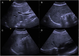 Ultrasonido de hígado y vías biliares. Colelitiasis sin dilatación intra y extrahepática. A) Conducto colédoco de 4mm, no dilatado. B y C) Vesícula biliar con múltiples litos en su interior. D) Vía biliar intrahepática sin dilatación.