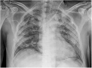 Radiografía de tórax en el día 6 de hospitalización: patrón alveolar difuso.