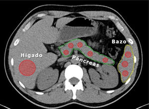Cálculo medición densidad de parénquima hepático en un ROI (region of interest) extenso a nivel de segmentos VI y VII en TAC.