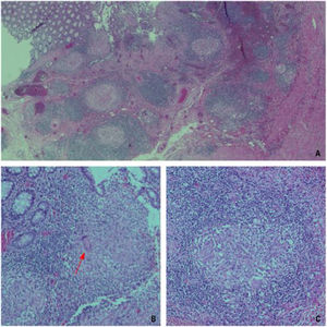Imágenes microscópicas de varios cortes de la pieza quirúrgica. A) Imagen 2.5x en la que se objetiva la mucosa ulcerada y la presencia de granulomas en lámina propia de la mucosa. B) Imagen 10x en la que se señala (flecha roja) la presencia de una célula gigante o de Langhans con sus característicos múltiples núcleos dispuestos en la periferia. C) Imagen 20x de un granuloma tuberculoso en el que se diferencia el collarete linfocitario que rodea a las células epitelioides.