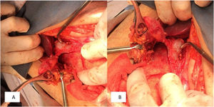 A,B) Trayecto fistuloso vesícula biliar-pared abdominal.