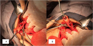 A,B) Conducto cístico de aproximadamente 5mm con presencia de dilatación de la vía biliar, sin litiasis coledociana.