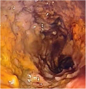 Se observa con mucosa edematosa, con patrón nodular, eritema y úlceras del bulbo duodenal.