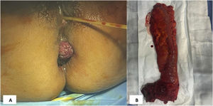 1A. Tumoración anal. 1B. Pieza de resección abdominoperineal.