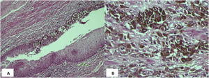 2A. Mucosa en canal anal con infiltración de células neoplásicas en la unión. 2B. Tejido conectivo con pigmento de melanina que se extiende de manera lentiforme.